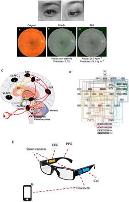 Computer Vision for Brain Disorders Based Primarily on Ocular Responses